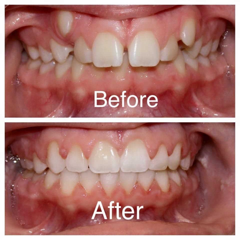 Before and after photo of crowded, spaced front teeth straightened with orthodontic treatment