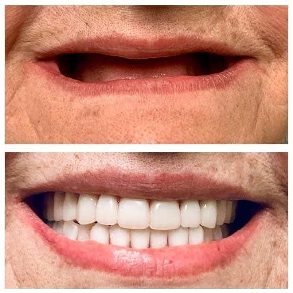 Before and after photo of a full arch dental rehabilitation at Dr. Neeraj's Dental Clinic, Ulwe