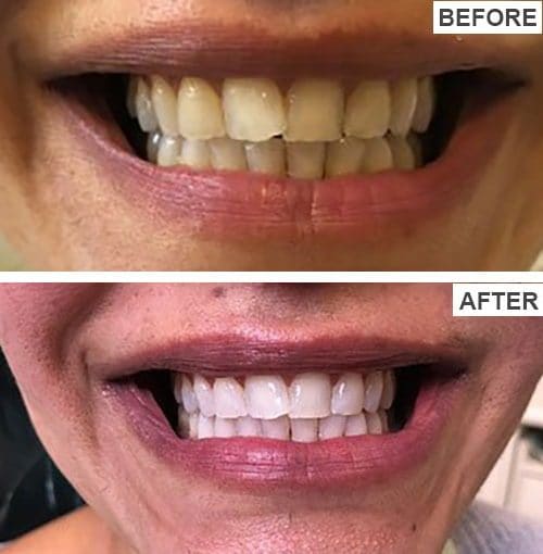 Before and after photo of an aesthetic smile makeover on the front teeth