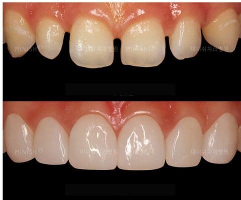 Before and after photo of front teeth reshaped and brightened with veneers